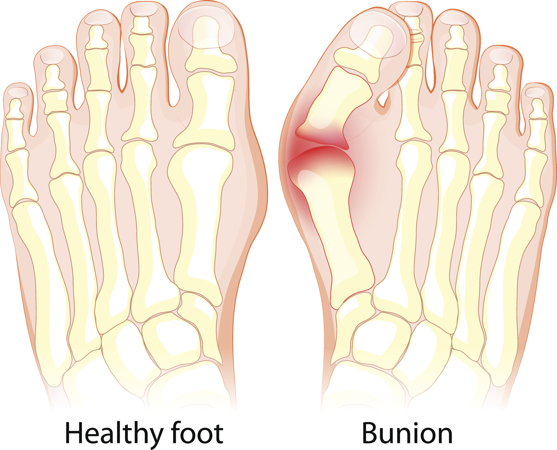 Image showing difference between healthy foot and a bunion