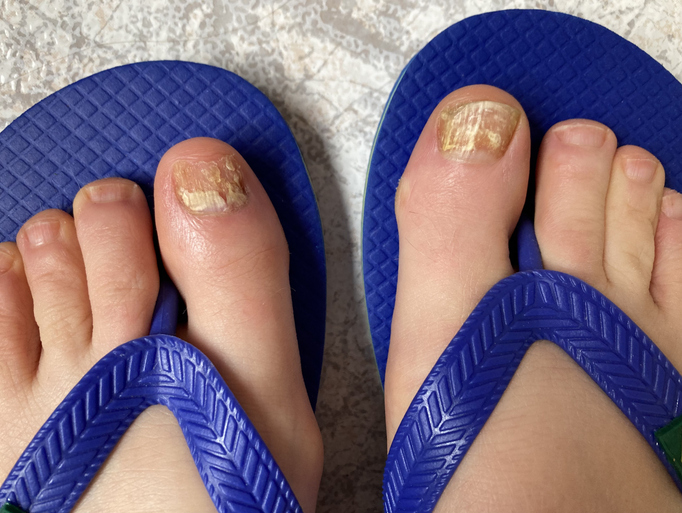 Image showing pair of feet in sandals with fungal nail