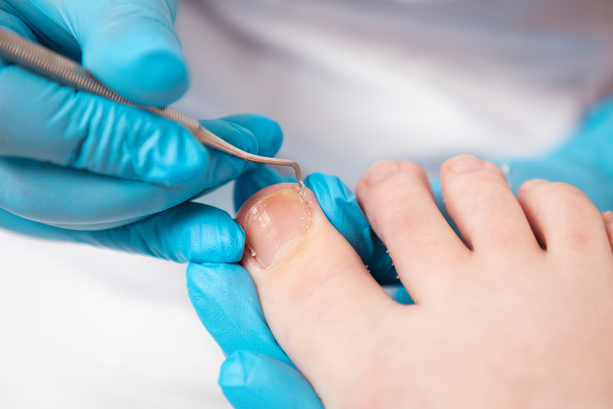 Image showing therapist fixing an ingrown nail