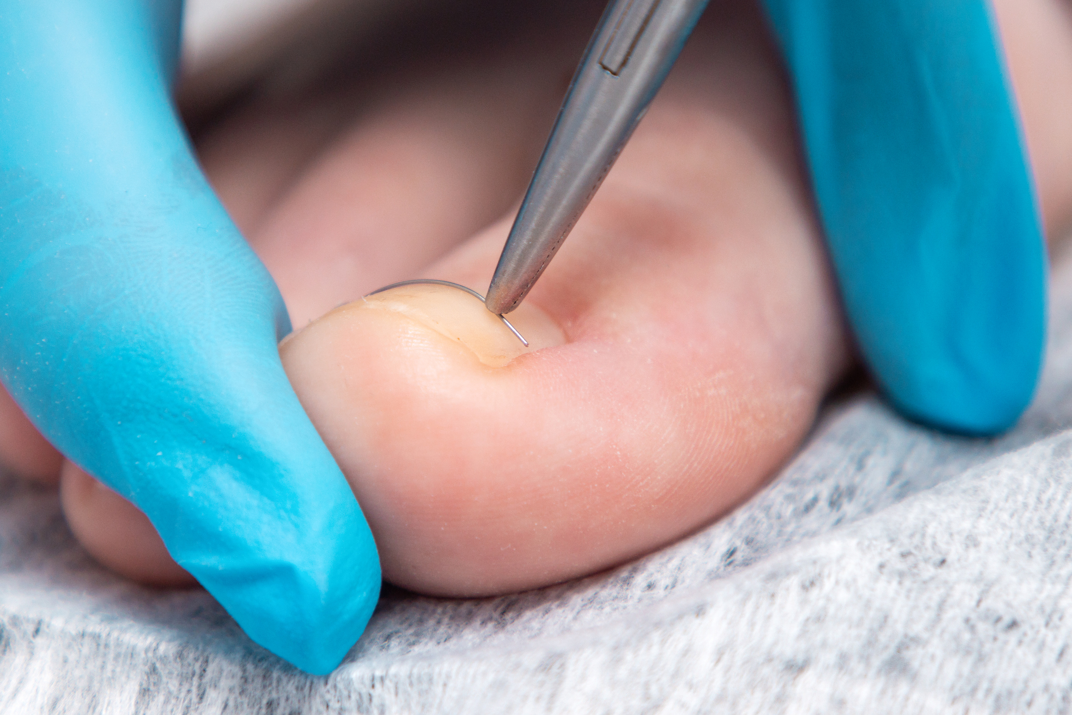 Image showing therapist fixing an ingrown nail